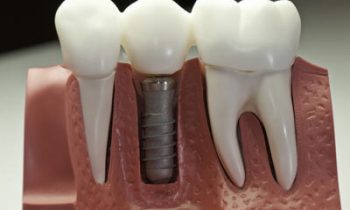 dental implants