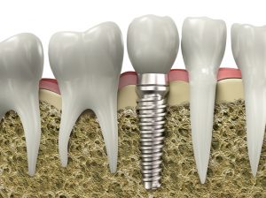 implant cosmetic dentistry