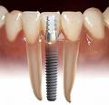 tooth extraction and implant