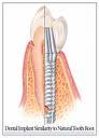 how soon after tooth extraction can you have an implant