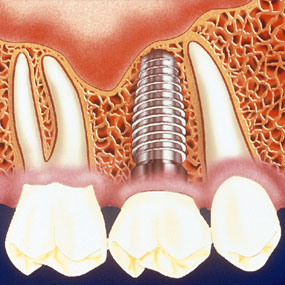 Complications with Dental Implants