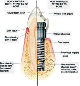 Los implantes dentales