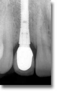 Dental Implant financing