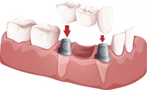 puente para implante dental