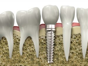 are Dental Implants painful