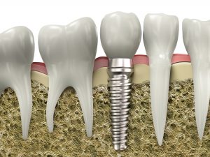 Dental Implants