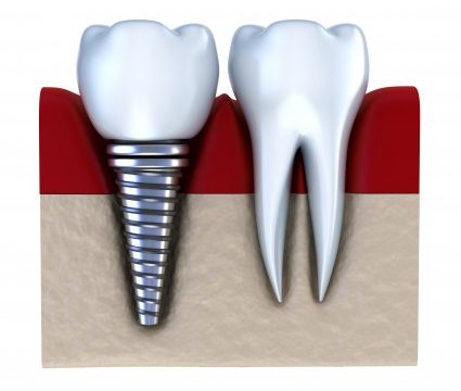 dental implants Rockville MD