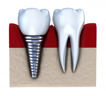 dental implants Rockville MD
