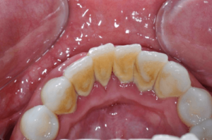 periodontitis disease