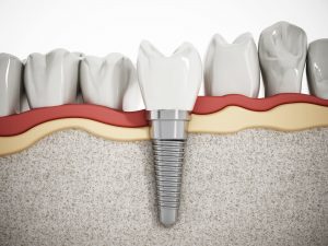 How much do dental implants cost per tooth