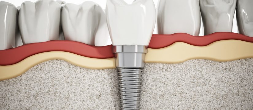 Dental Implant rockville md
