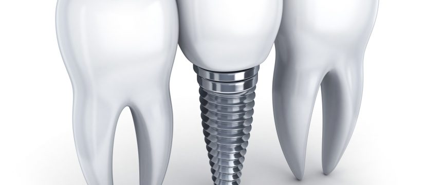 Dental implant and tooth