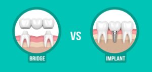 bridge vs implant cost