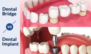 dental implants vs bridge