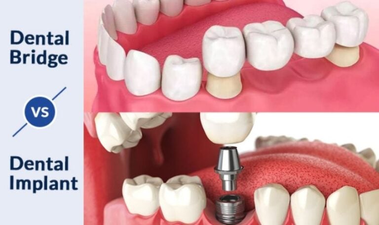 What Is a Dental Bridge? | Tooth Replacement in Rockville