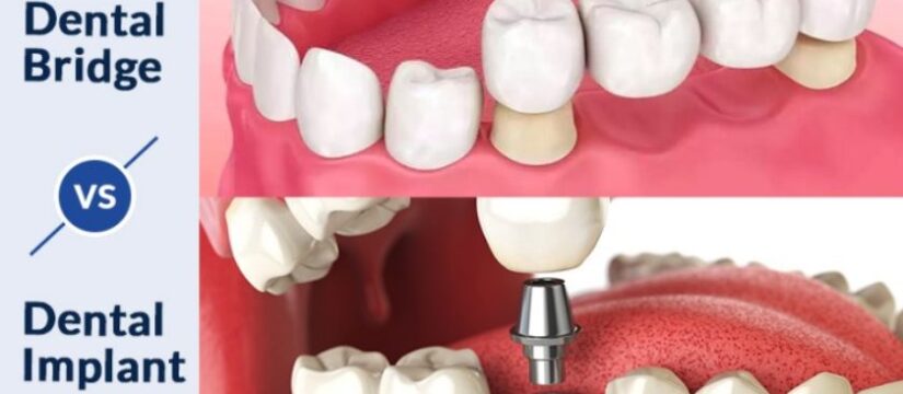 What is a Dental Bridge Cost Vs Implant? Comparing Pros, Cons, and Costs