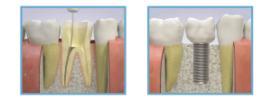 implante dental vs conducto radicular