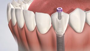 how much dental implant cost