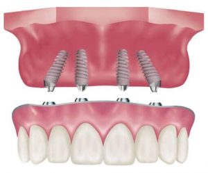 full mouth Dental Implants