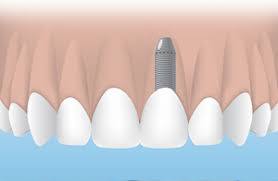 Tooth Extraction and Implant Timeline