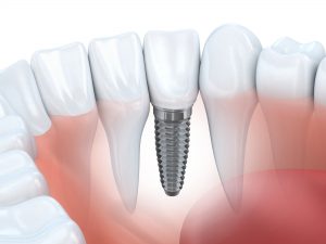how do teeth implants work