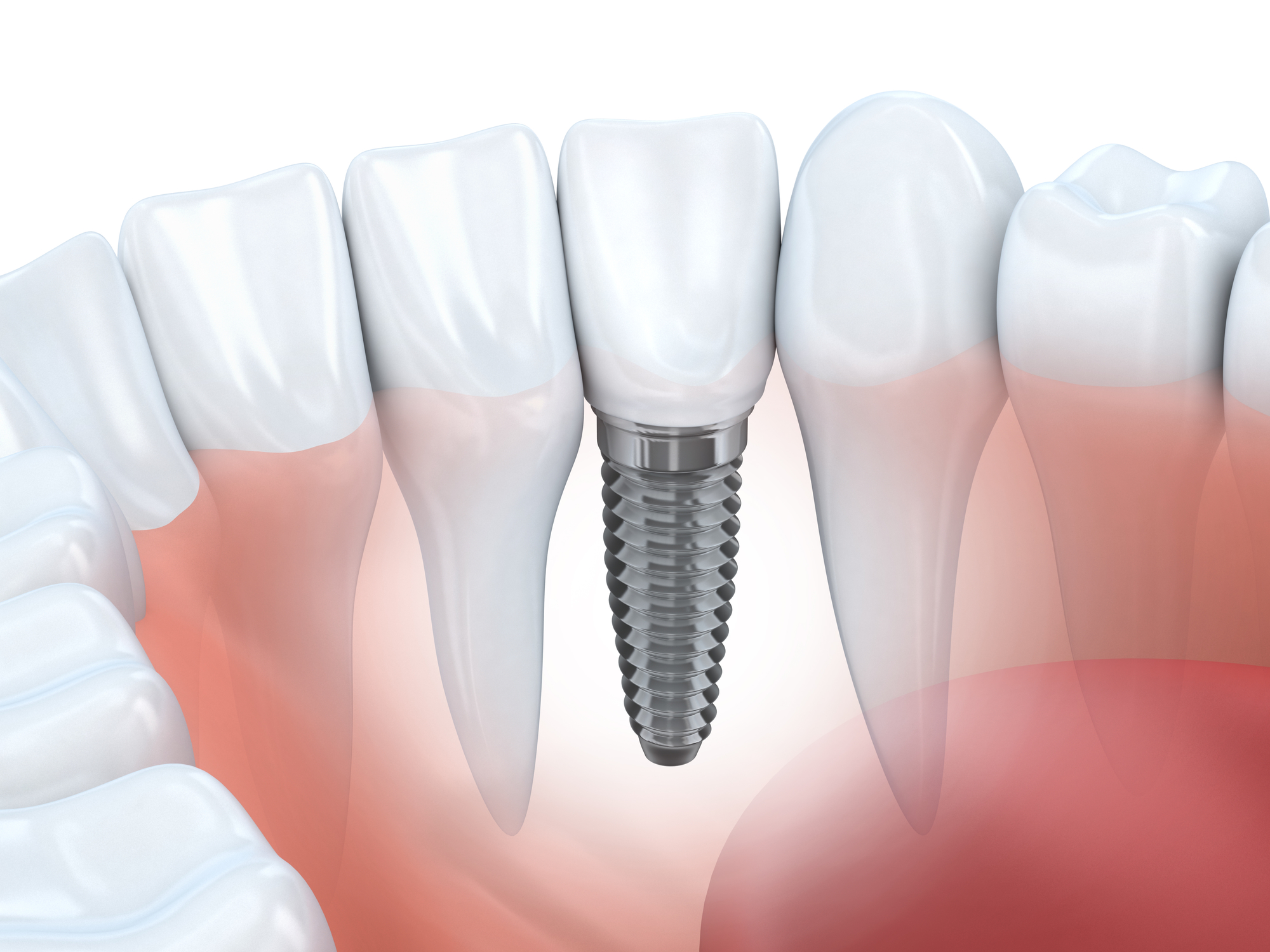 Conmoción adherirse haz Costo de los Implantes Dentales | Implantes Dentales Precios