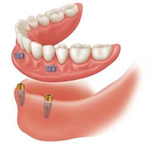 dentures vs. implants