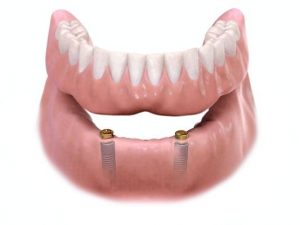 snap-on implant dentures
