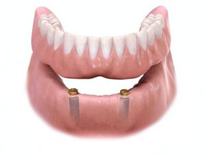 implant retained dentures