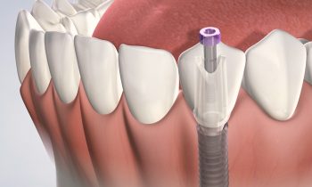 Dental Implant