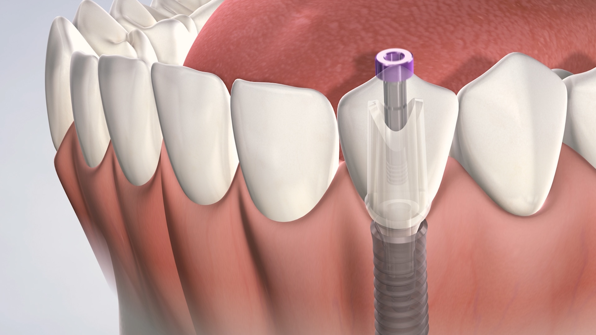 Full Dental Implants Cost Dentist Rockville MD