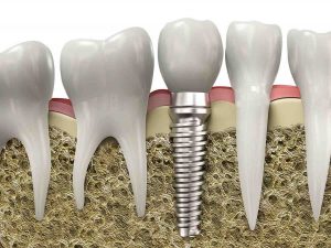 implantes dentales