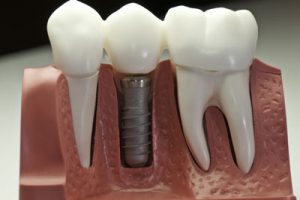 Dolor de implante dental
