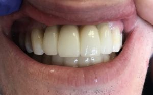 front dental implant bridge