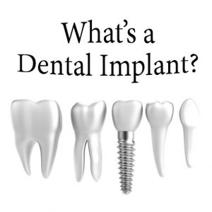 imagen que es implante dental