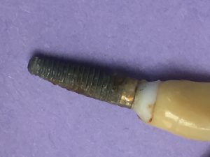 a failed dental implant