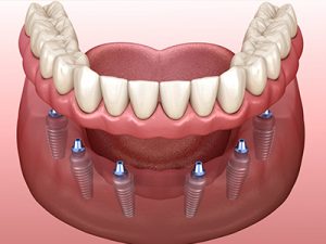 full mouth dental implants