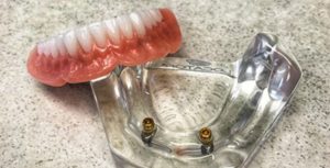 snap in dentures cost