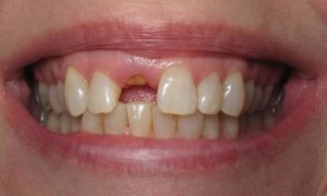 dental implants gaithersburg md