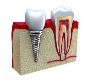 are dental implants as strong as real teeth