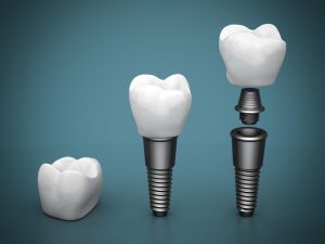Tiempo de recuperación para implantes dentales