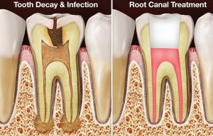 root canal removal