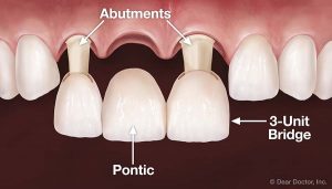 front tooth dental bridge