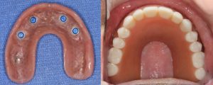 palateless upper denture