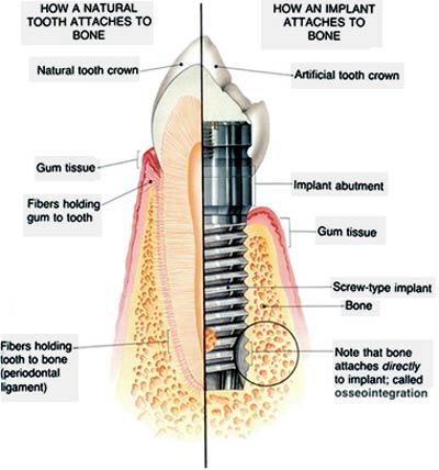 implant abutment and crown
