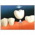 how long does a dental implant take