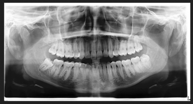 wisdom tooth broke off to gum line