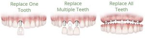 teeth implant replacement options x
