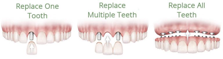 replace teeth with dental implants