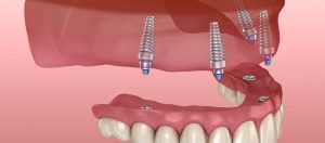 dental implant procedure steps
